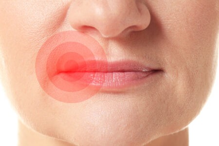 Achtung Lippenherpes!